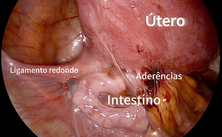 Pelve com Endometriose