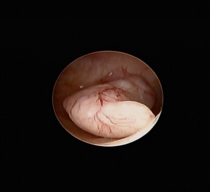 Pólipo Uterino